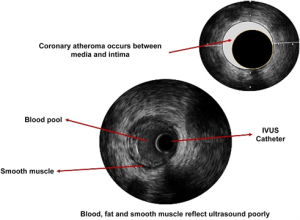 Complex coronary angioplasty (Rota/ IVL/ IVUS/ OCT) guided