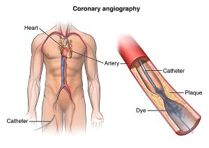 Coronary Angiography ( radial route)