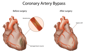 Post bypass angioplasty